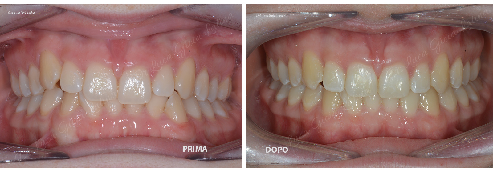 Ortodonzia Invisalign a Latina - Centro Odontoiatrico Gioia