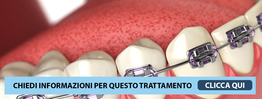 Ortodonzia Fissa - Apparecchio Dentale Fisso latina